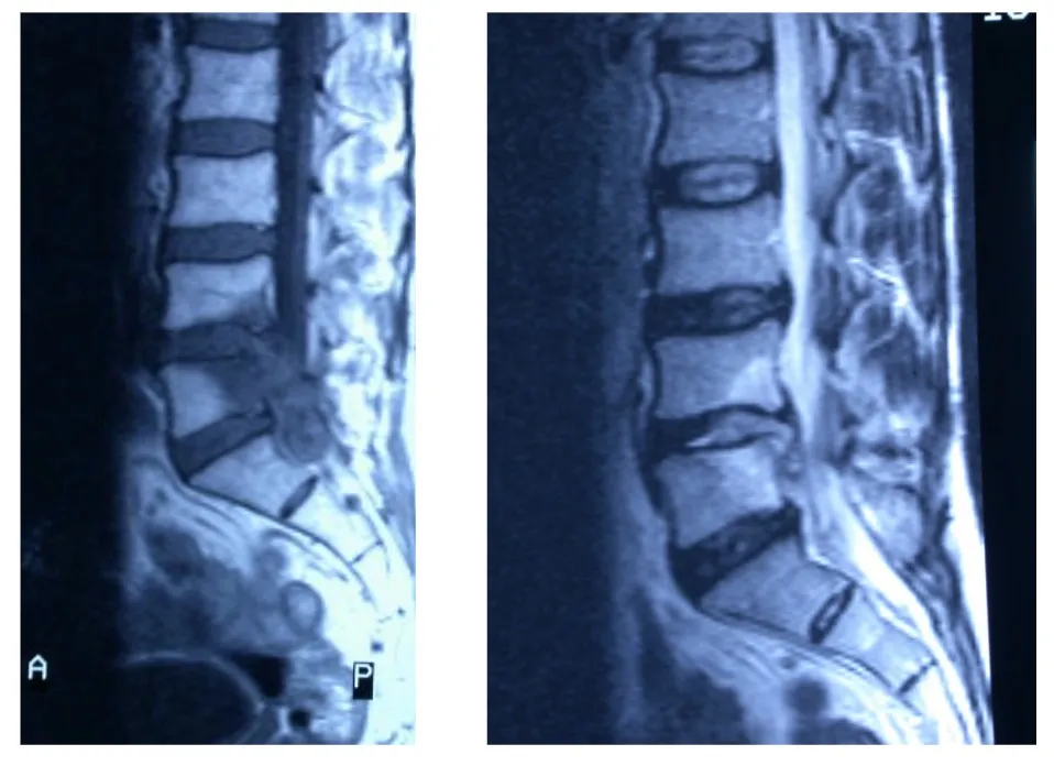 Brucelosis o fiebre de Malta. Resonancias magnéticas que muestran afectación discal e inflamación de cuerpos vertebrales lumbares.