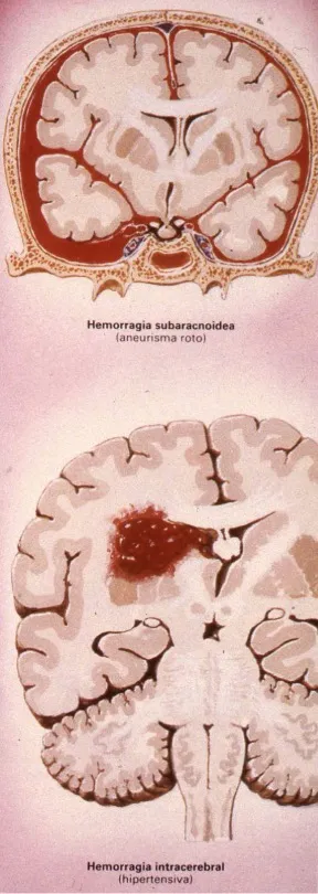 Tipos de ictus hemorrágico: hemorragia subaracnoidea (superior) y hemorragia intraparenquimatosa (inferior)