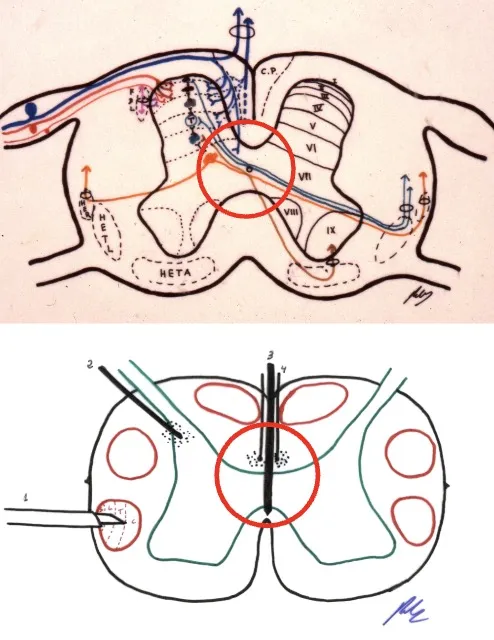 Técnicas de mielotomía para dolor bilateral: mielotomía comisural (Armour 1927, Leriche 1942, Follet 2004) y mielotomía extralemniscal (Hitchcock 1970, Schvarcz 1976, Nauta et al. 2000). Los diagramas muestran los niveles de sección en la médula espinal y el tronco cerebral.