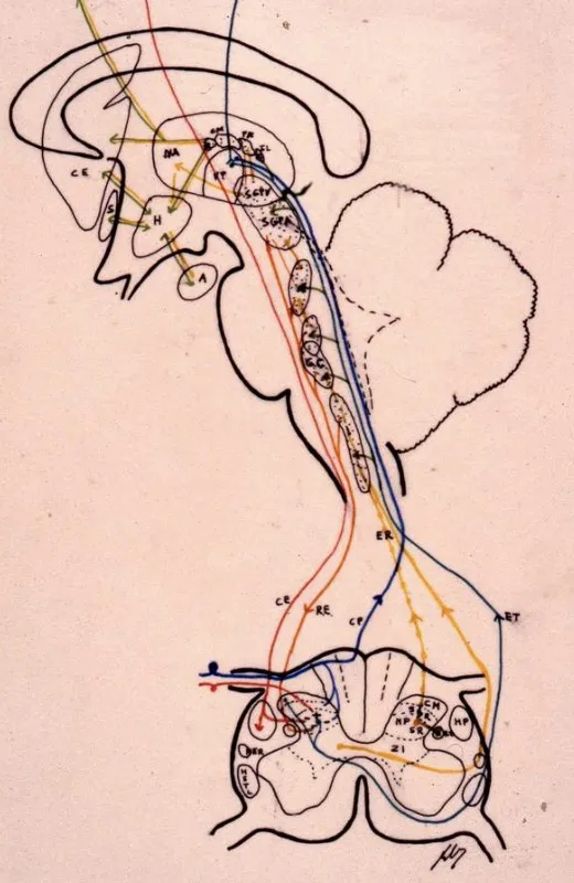 Mesencefalotomía estereotáctica que actúa sobre el tracto espinotalámico a nivel mesencefálico. Está indicada especialmente para dolor facial oncológico. Presenta una mortalidad del 1-2%. Técnica descrita por Frank et al. 1987, Kim et al. 2014 y Fountas et al. 2004.