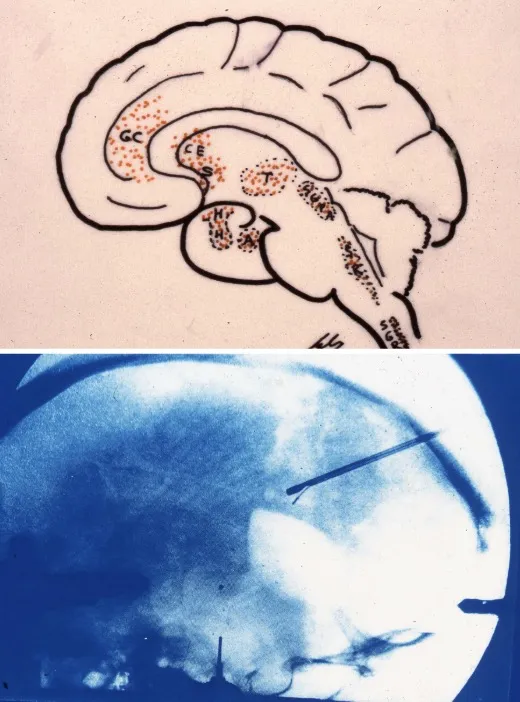 Cingulotomía mediante radiofrecuencia o lesión termal guiada por resonancia magnética. Logra mejoría del dolor en 32-83% de los casos. Presenta alteraciones cognitivas leves y pasajeras como disminución en la atención, apatía y menor actividad. Medicina basada en la evidencia con nivel B-C-D. Múltiples publicaciones: Hassenbusch (Neurosurgery 1990), Wong (Clin J Pain 1997), Pillay (Stereotact Funct Neurosurg 1992), Yen (J Clin Neurosci 2009), Viswanathan (Neurosurg Focus 2013), Pereira (Br J Neurosurg 2014), Patel (Neurosurgery 2015).