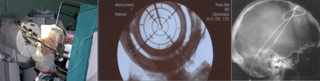 Núcleos subcorticales susceptibles de estimulación versus lesión. El diagrama muestra los diferentes núcleos que pueden ser diana terapéutica mediante técnicas estereotácticas: globo pálido externo (Gpe) e interno (Gpi), núcleo subtalámico (NST), sustancia negra, núcleos talámicos (Voa/Vop, Vim, Vc, reticularis, centromediano, ventromedial), núcleo rojo, núcleos intralaminares, hipotálamo y núcleo accumbens.