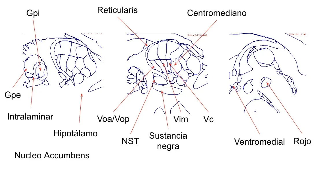 Conocimiento neurofisiológico detallado de los núcleos subcorticales, fundamental para la cirugía estereotáctica funcional. Los diagramas muestran la localización precisa de cada núcleo en cortes axiales del cerebro.