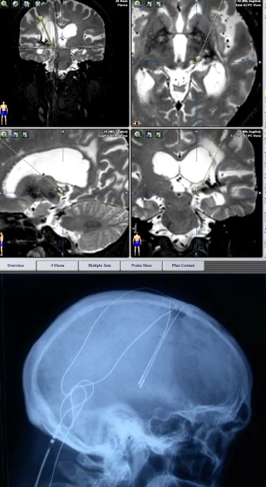 Neuroestimulación talámica a nivel de los núcleos VPM-VPL (núcleo ventral posteromedial y posterolateral) y PAG-PVG (sustancia gris periacueductal y periventricular). Indicada tanto para dolor nociceptivo como para dolor por desaferentización.