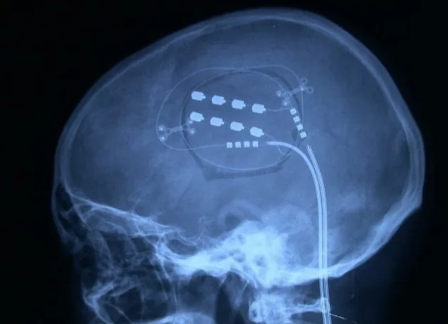 Estimulación de la corteza motora mediante mallas de electrodos colocadas sobre la superficie cerebral, indicada especialmente para dolor por desaferentización.