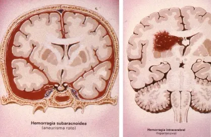 Tipos de hemorragia cerebral: hemorragia subaracnoidea (imagen superior) y hemorragia intraparenquimatosa (imagen inferior) en tomografía computarizada