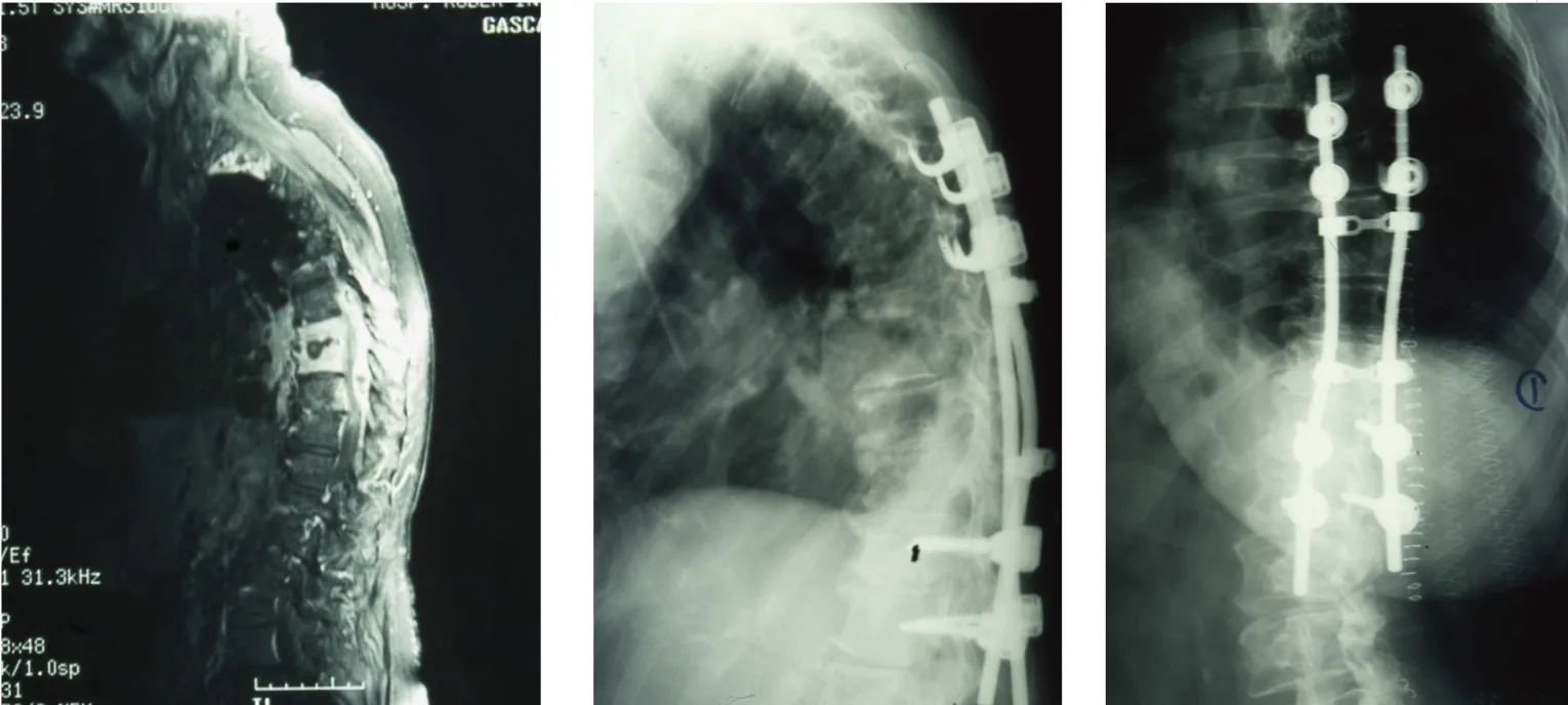 Tuberculosis vertebral. Resonancia magnética mostrando extensa afectación de múltiples cuerpos vertebrales dorsales y radiografías de control postquirúrgico con instrumentación anterior y posterior.