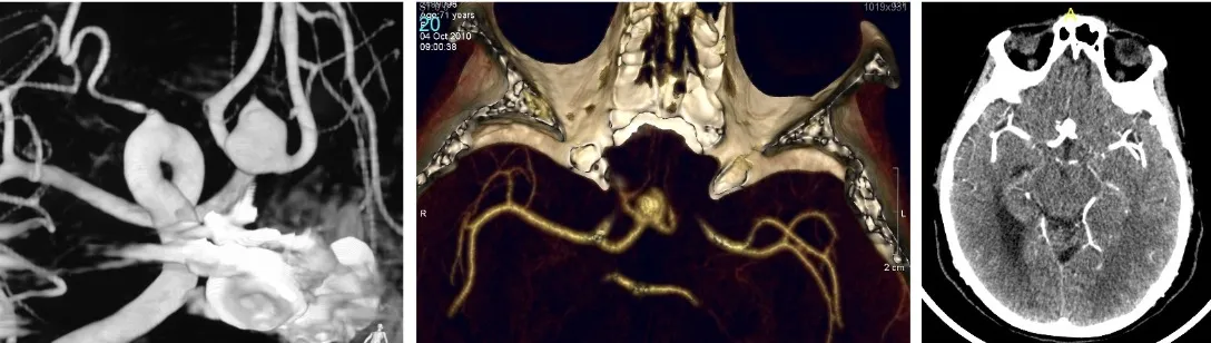 Concepto de aneurisma cerebral: imágenes de angiografía y angio-TAC mostrando aneurismas saculares