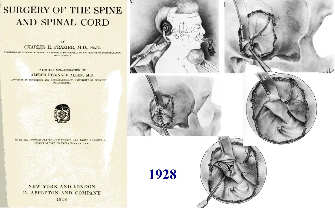 Libro de Charles H. Frazier "Surgery of the Spine and Spinal Cord" (1918) y técnicas quirúrgicas de rizotomía del ganglio de Gasser realizadas en 1928.
