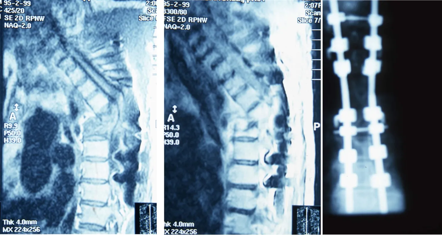 Tuberculosis vertebral. TAC y radiografías mostrando la evolución del tratamiento con instrumentación.