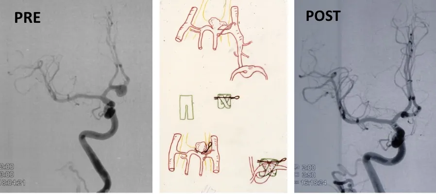 Aneurisma cerebral: arteriografía preoperatoria (izquierda), esquema del clipaje quirúrgico (centro) y control arteriográfico postoperatorio (derecha)