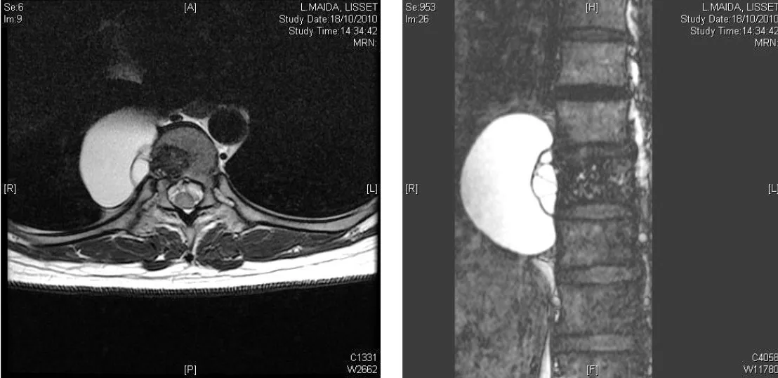 Quiste hidatídico vertebral e infecciones fúngicas en pacientes inmunodeprimidos. Resonancias magnéticas axial y sagital mostrando lesiones quísticas.