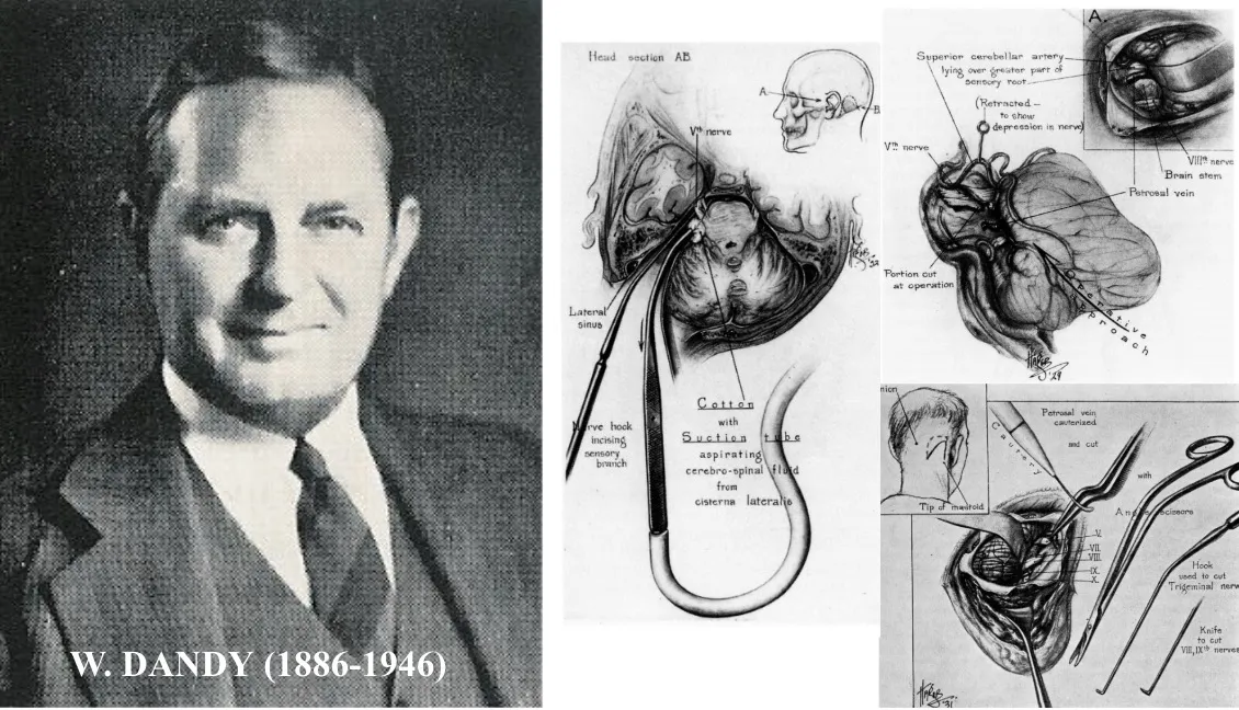W. Dandy (1886-1946) y técnica de rizotomía en fosa posterior. Dandy desarrolló el abordaje a la raíz del trigémino en su entrada al tronco cerebral.