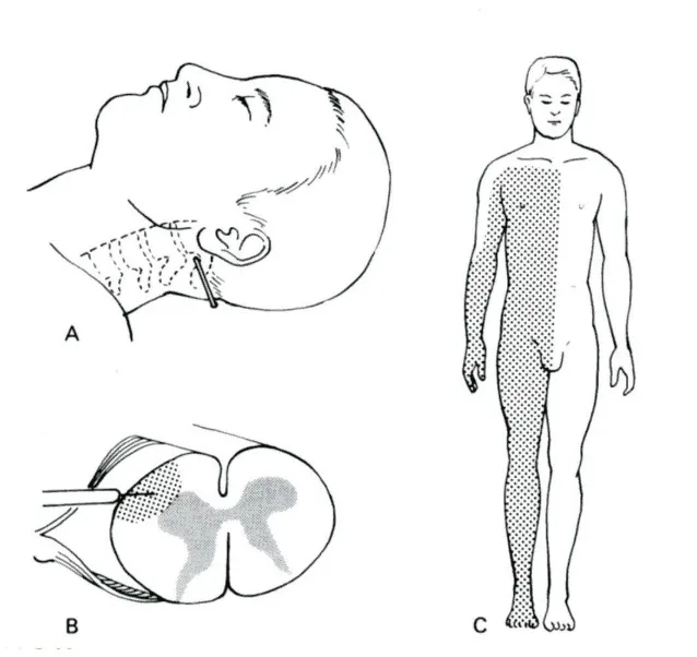 Diferentes técnicas quirúrgicas desarrolladas para el tratamiento del dolor a nivel medular y radicular, incluyendo el bloqueo anestésico diagnóstico (Leriche, White), la simpatectomía (Leriche 1913), la rizotomía espinal (Abbe y Bennett 1889), y la cordotomía percutánea (Martin y Spillen 1912).