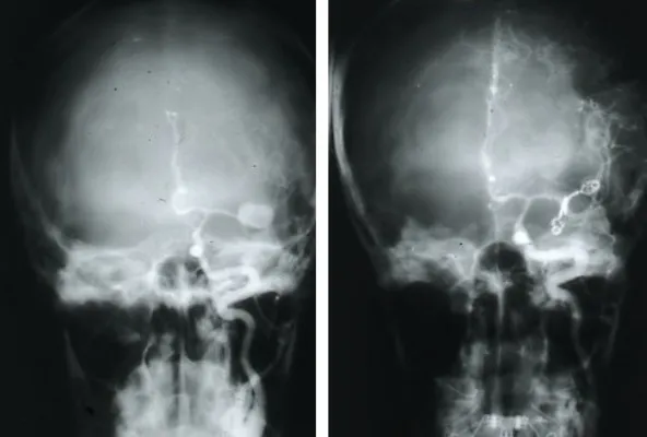 Etiopatogenia de los aneurismas: angiografías mostrando aneurismas en bifurcaciones arteriales