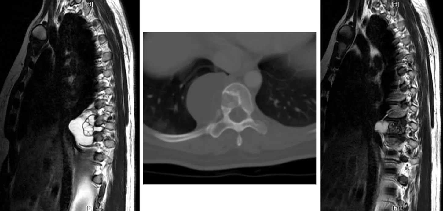 Hidatidosis vertebral. Múltiples resonancias magnéticas y TAC axial mostrando quiste hidatídico en cuerpo vertebral.