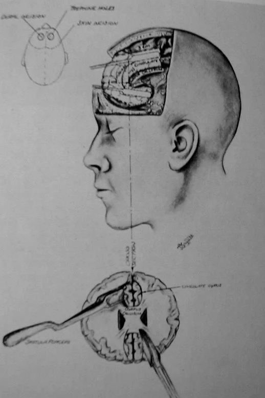 Desarrollo de la psicocirugía para el tratamiento del dolor. Spiegel y Wicis realizaron talamotomía dorsomedial en 1947, mientras que Scoville, Jow y Witty desarrollaron la cingulotomía anterior entre 1940 y 1953. Investigaciones publicadas por Pedrosa y Sola en 2003 y Hernando, Sola et al. en 2004 en Revista de Neurología.
