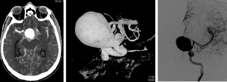 Evolución de los aneurismas: TAC cerebral, angio-TAC y arteriografía mostrando un aneurisma gigante