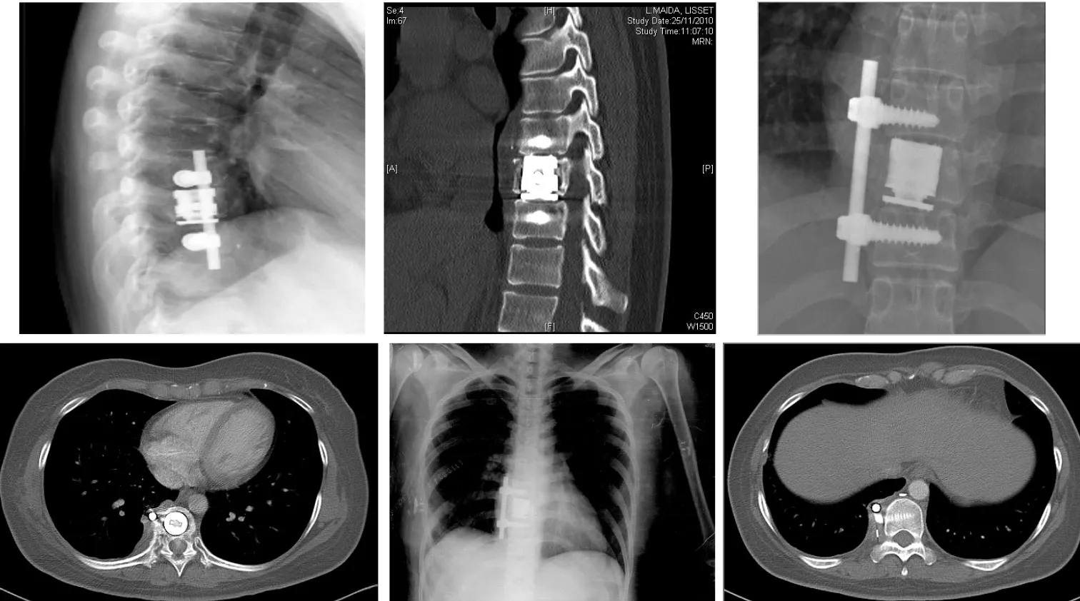 Hidatidosis vertebral. Evolución radiológica pre y postquirúrgica, TAC de control y radiografía de tórax mostrando quiste pulmonar asociado.