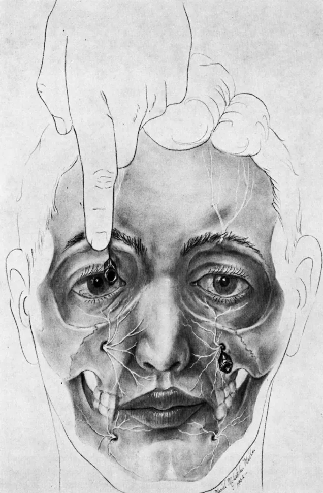 Síndromes miofasciales (lumbalgias, failed back syndrome, fibromialgia) y dolor craneofacial (neuralgia esencial del trigémino, neuralgia facial atípica, neuralgia postherpética, anestesia dolorosa de la cara, cefaleas, otras neuralgias). Imagen de territorios de inervación facial.