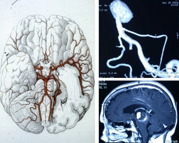 Localización de los aneurismas en el polígono de Willis y los grandes vasos cerebrales