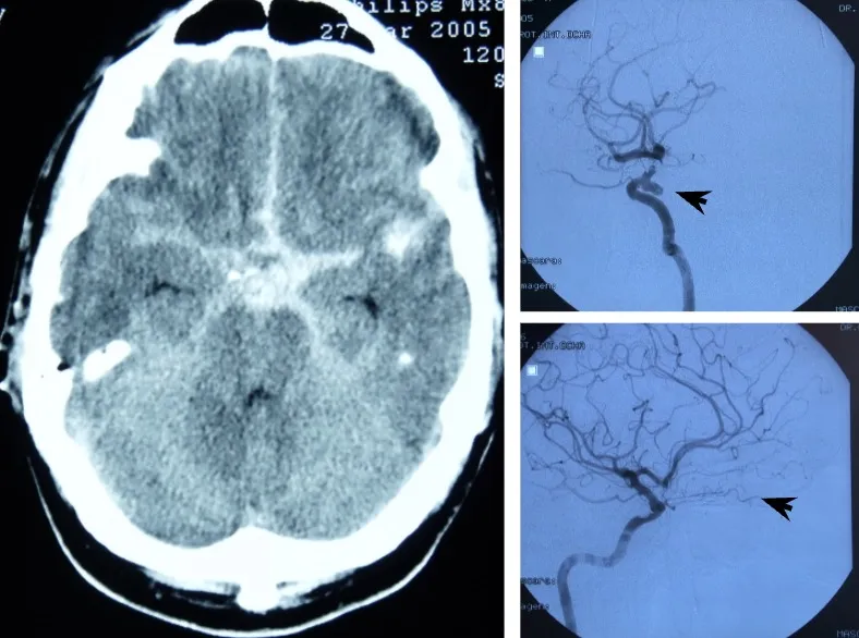 Diagnóstico de hemorragia subaracnoidea: TAC cerebral mostrando sangre (izquierda) y arteriografía cerebral identificando el aneurisma (derecha)