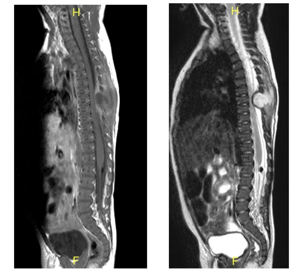 Espondilodiscitis en lactante. Resonancias magnéticas cervicales mostrando extensa afectación infecciosa en paciente pediátrico.