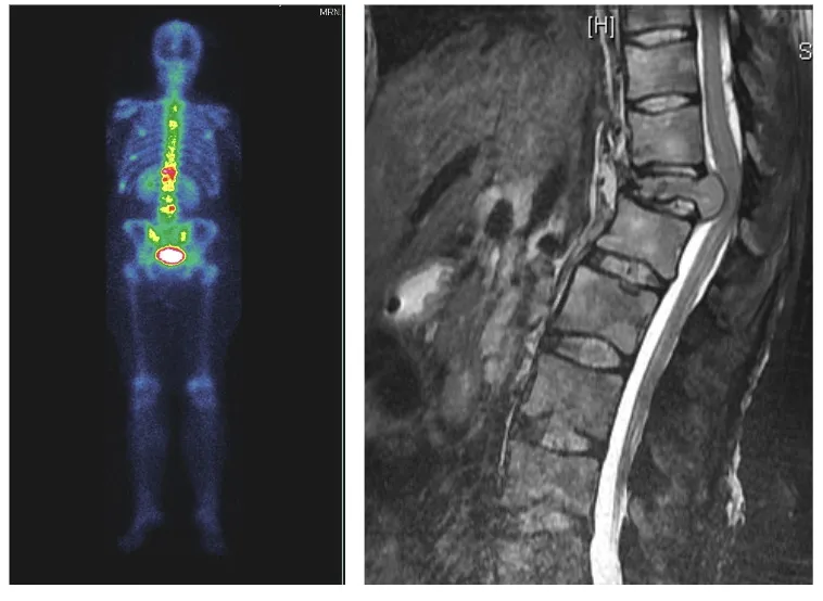 Síndromes de desaferentización (miembro doloroso fantasma, arrancamiento plexo braquial, sección medular, síndrome de Dejerine, postquirúrgicos) y dolor en cáncer maligno (componente nociceptivo y desaferentización, expectativa de vida aumentando). Imágenes de PET-TC y resonancia magnética mostrando lesiones medulares.