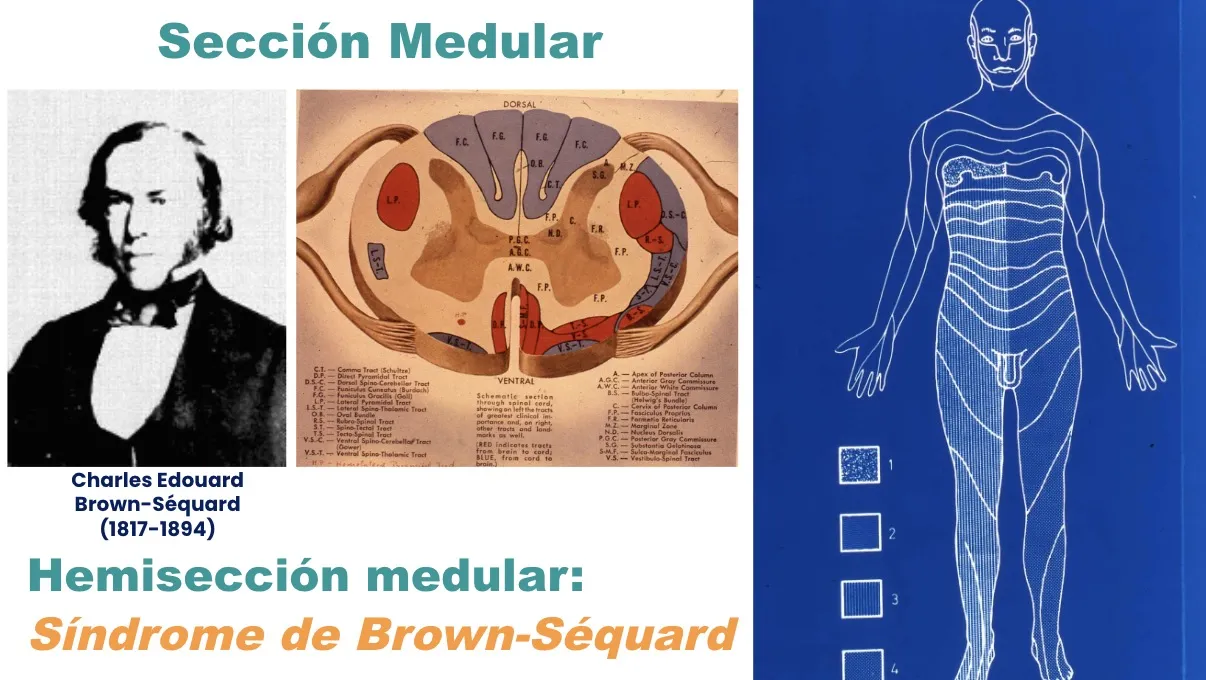 Figura 10.- Charles Edouard Brown-Séquard (1817-1894), descriptor del síndrome de hemisección medular.