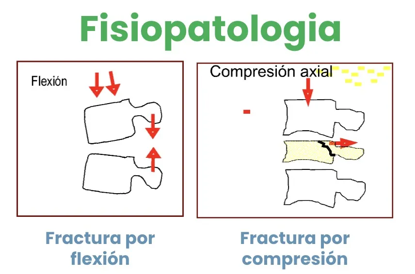 Figura 11.- Mecanismos de fractura por flexión y por compresión.
