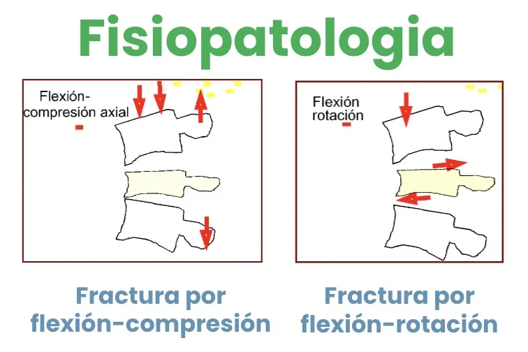Figura 12.- Fracturas por flexión-compresión y flexión-rotación, los mecanismos más graves.