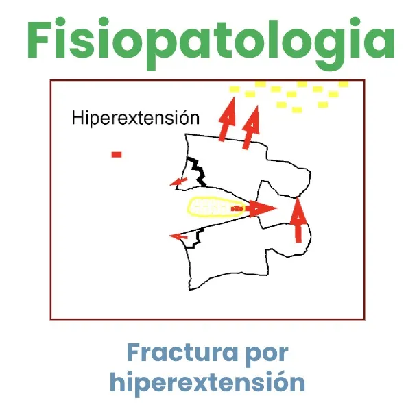 Figura 13.- Fractura por hiperextensión, mecanismo menos frecuente.