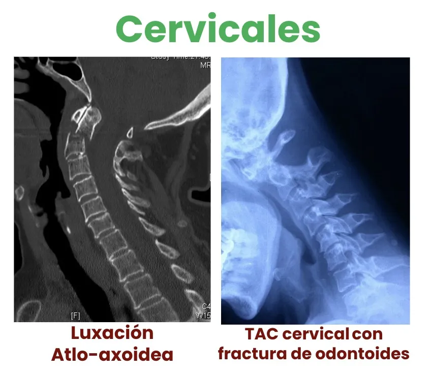 Figura 14.- TAC cervical con fractura de odontoides.