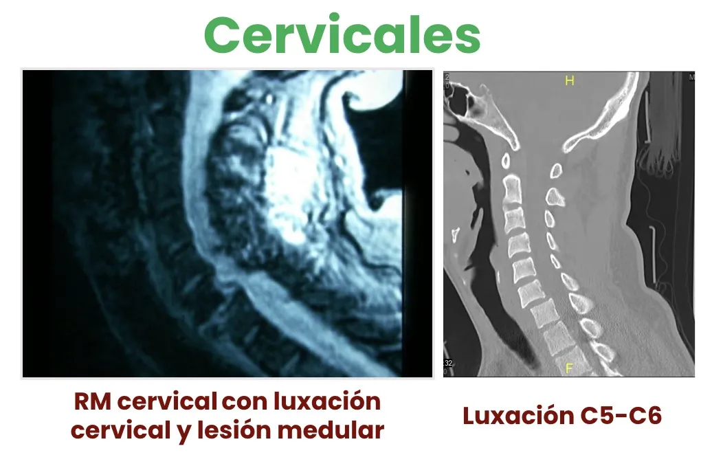 Figura 15.- RM cervical que muestra luxación C5-C6 con lesión medular asociada.