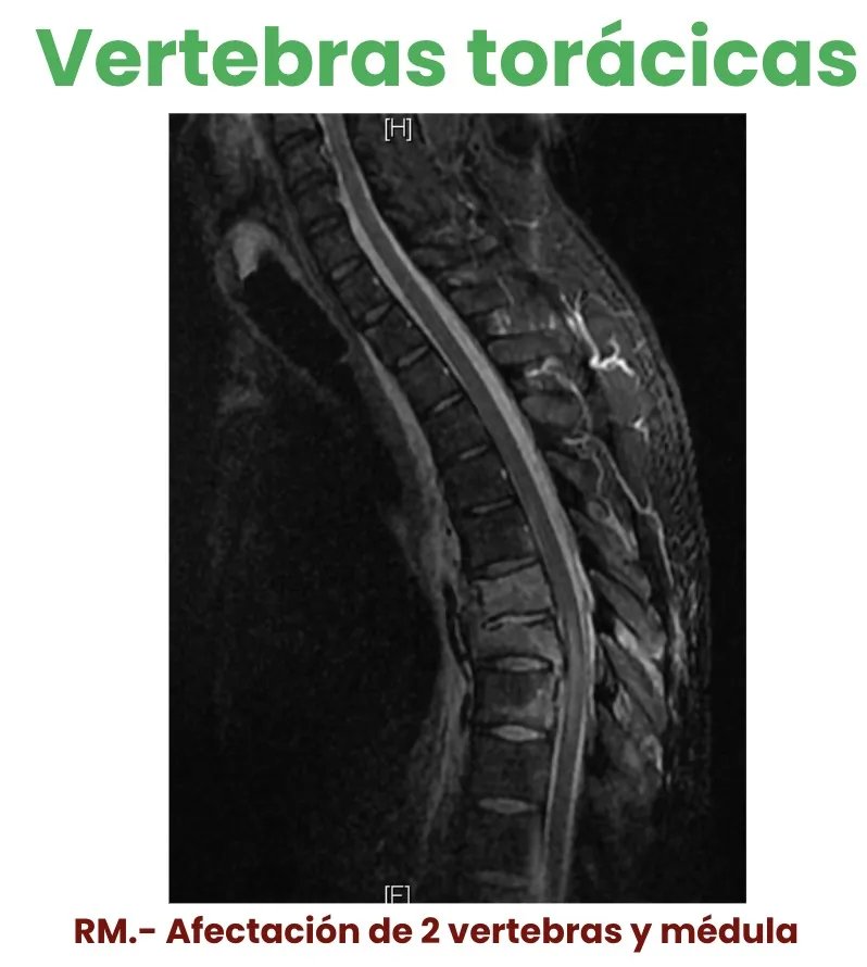 Figura 16.- RM con afectación de dos vértebras torácicas y de la médula.