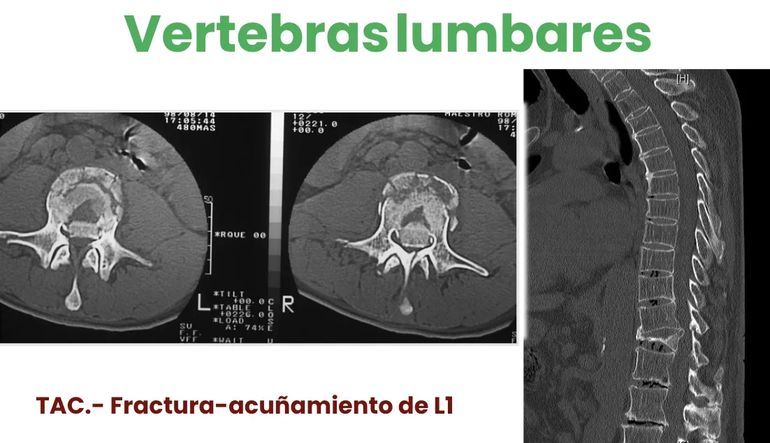 Figura 17.- TAC con fractura-acuñamiento de L1.