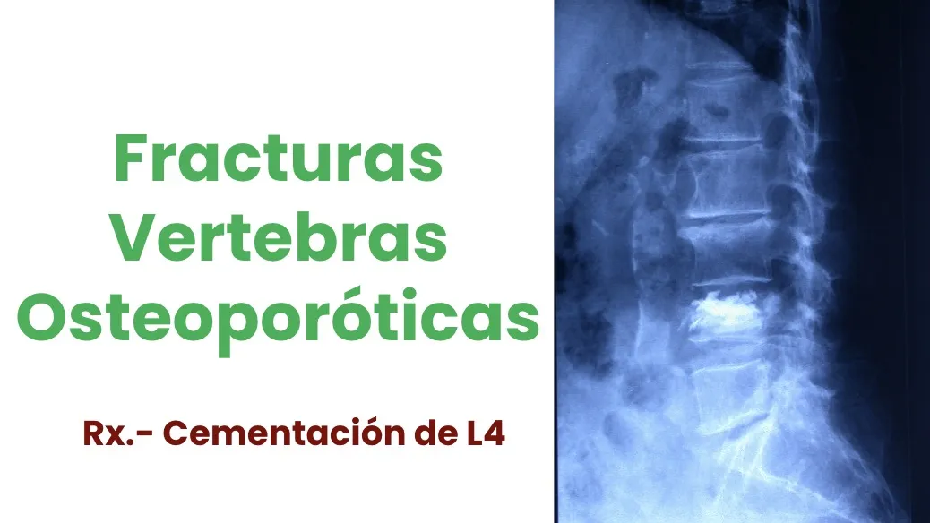 Figura 18.- Cementación vertebral (vertebroplastia) en fractura osteoporótica de L4.