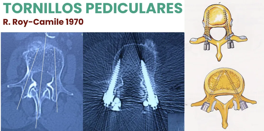 Figura 27.- Tornillos pediculares (R. Roy-Camille, 1970).