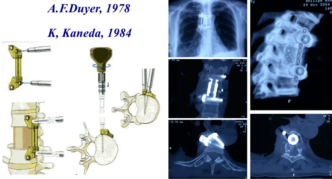 Figura 28.- Instrumentación anterolateral (Dwyer, 1978; Kaneda, 1984).