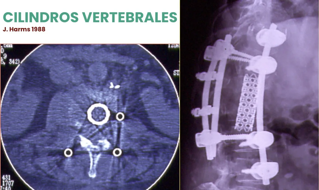 Figura 29.- Cilindros vertebrales expandibles (J. Harms, 1988) para sustitución de cuerpos vertebrales.