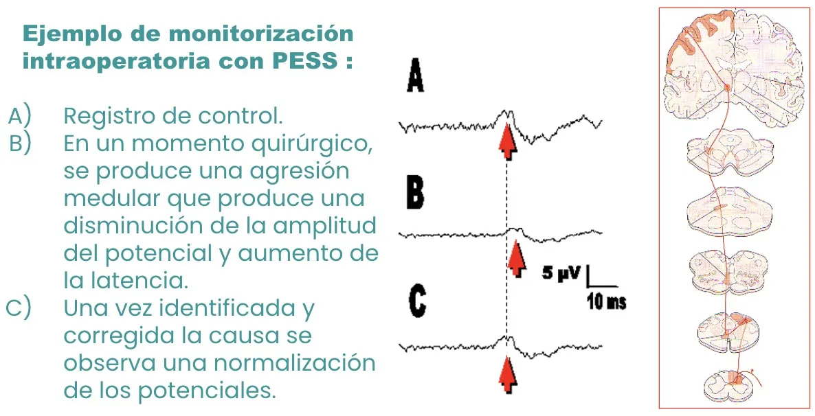 Figura 30.- Monitorización intraoperatoria con PESS: registro de control y respuesta ante una agresión medular.