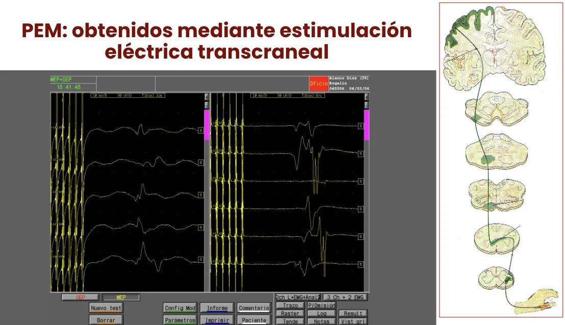 Figura 31.- Potenciales evocados motores obtenidos mediante estimulación eléctrica transcraneal.
