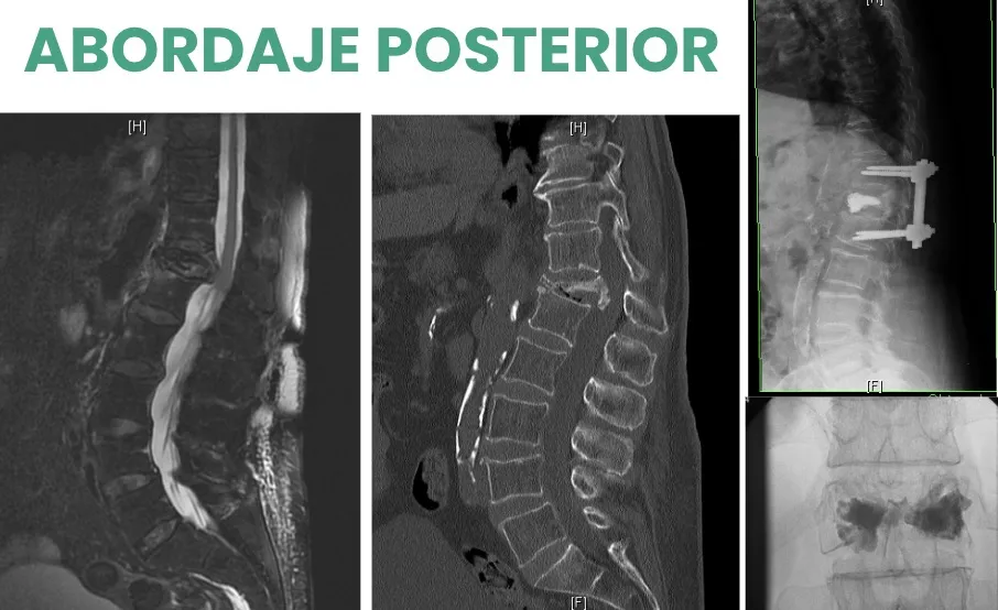 Figura 32.- Abordaje posterior en la charnela tóraco-lumbar: fractura grave de D12 corregida.