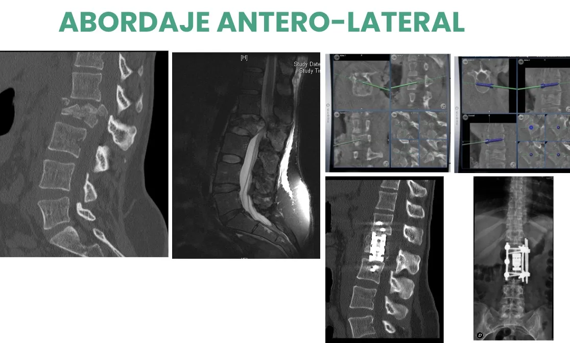 Figura 33.- Abordaje antero-lateral lumbar: extirpación del cuerpo vertebral de L2 y sustitución por cilindro expandible.