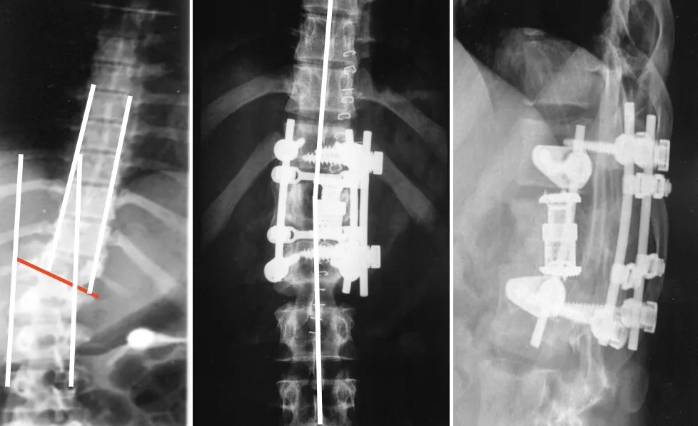 Figura 34.- Corrección de una fractura por cizallamiento con instrumentación extensa.