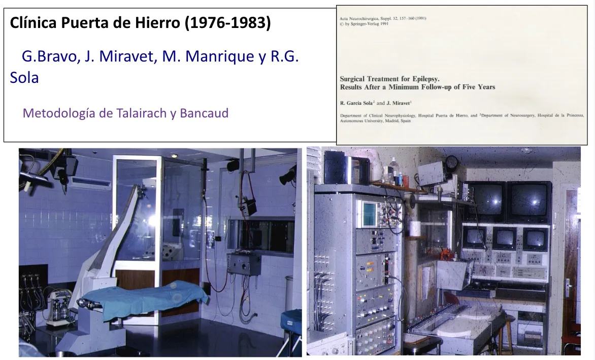 Figura 1.- Fotografía del equipo de la Clínica Puerta de Hierro (1976-1983): los doctores G. Bravo, J. Miravet, M. Manrique y R. García de Sola, pioneros de la cirugía de la epilepsia en España