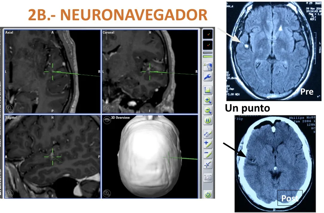 Figura 11.- Neuronavegador aplicado a la localización de un punto concreto en el interior del cerebro