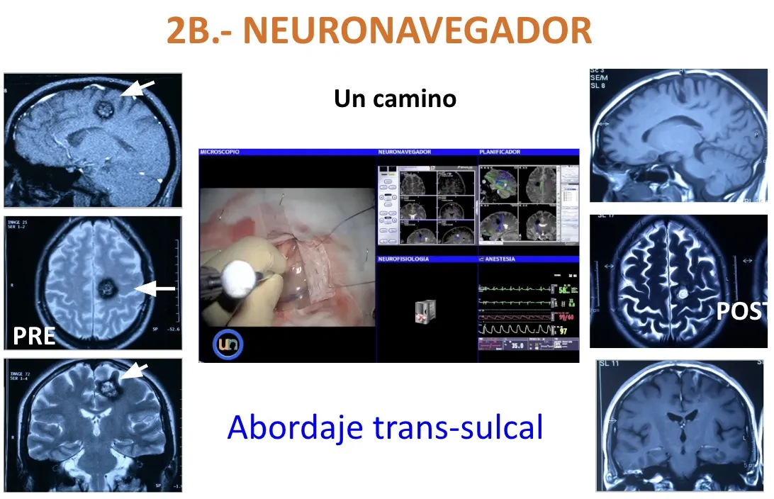 Figura 12.- Abordaje trans-sulcal guiado por neuronavegador, con imágenes pre y postoperatorias