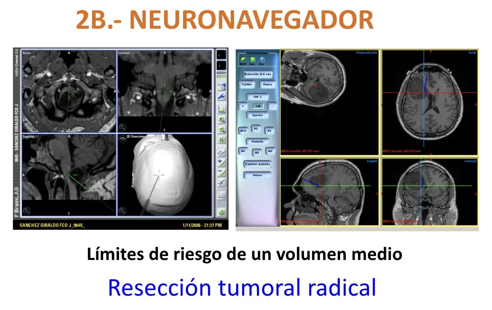 Figura 13.- Delimitación de los límites de riesgo de un volumen tumoral medio mediante neuronavegador, para una resección tumoral radical