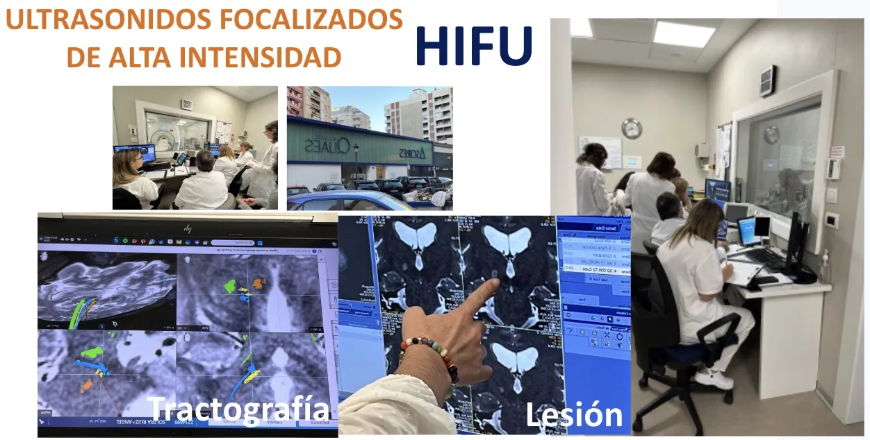 Figura 17.- Sistema de ultrasonidos focalizados de alta intensidad (HIFU): tractografía y lesión resultante